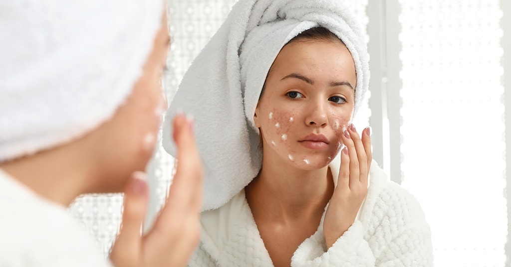 The Best Acne Treatment Products in South Africa